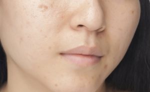 چگونه جای جوش و آکنه را ازبین ببریم ؟