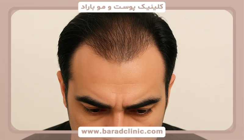 اقدامات ضروری قبل از کاشت مو راهنمای جامع برای نتیجهای طبیعی و موفق 10 آشنایی با فرایند کاشت مو و اهمیت آماده-سازی قبل از عمل.